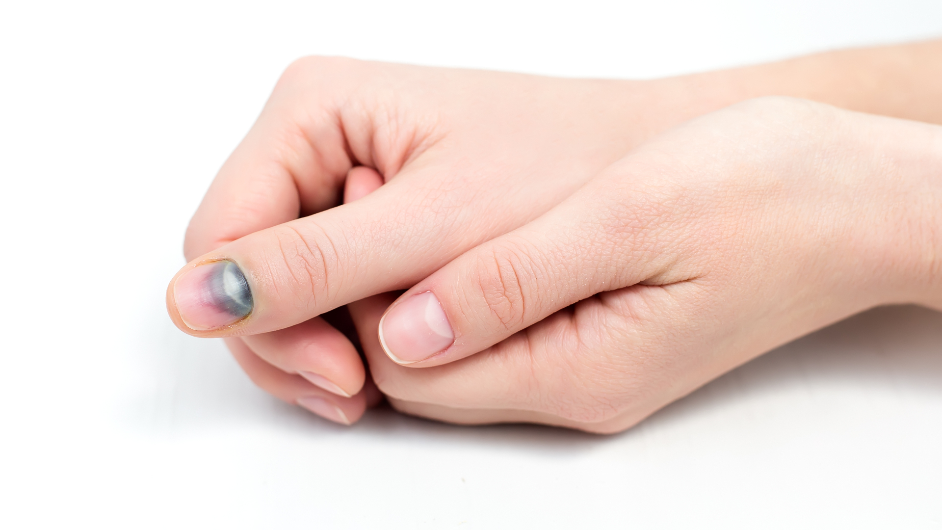 woman's nail with green nail syndrome